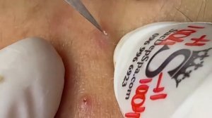 Выдавливание прыщей, угрей, черных точек и камедонов #259