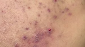 Лечение Акне у молодого парня