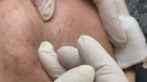 Себорея и акне: Сальные прыщи на лице. Лечение