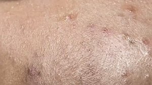 Лечение проблемных прыщей Linh #17