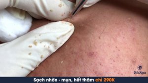 НЕ ПРОПУСТИ! Новое видео с удалением комедонов — залипнешь!