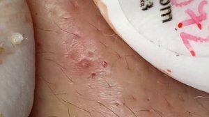 005 • Relax Spa • АСМР • Acne collection