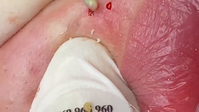 Выдавливание прыщей, угрей, черных точек и камедонов #261