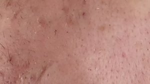 ЧЕРНЫЕ ТОЧКИ АТАКУЮТ! Часть 2 — Чистка лица от комедонов 😱 SDS#278