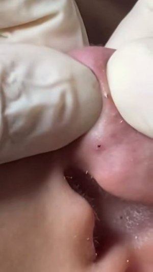 Чистка лица от угрей и акне. Выдавливание прыщей. Удаление черных точек и комедонов