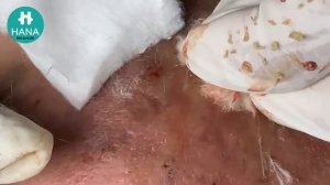 Лечение акне на разных зонах: лоб, щеки, подбородок HANA #11