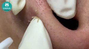 АНТИСТРЕСС: смотрим на лечение акне и расслабляемся HANA #10