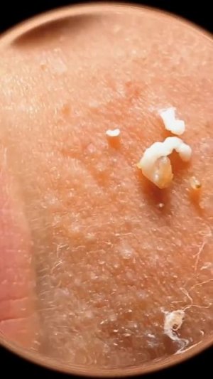 Чистка лица от угрей и акне. Выдавливание прыщей. Удаление черных точек и комедонов