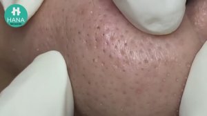 АНТИСТРЕСС: смотрим на лечение акне и расслабляемся HANA #10