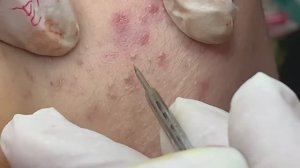 Комплексный подход к лечению угревой сыпи