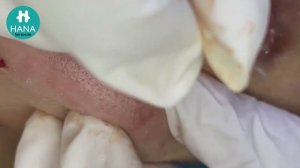 ЛЕЧЕНИЕ АКНЕ: удовлетворение и релакс в одном флаконе 😌 HANA #14