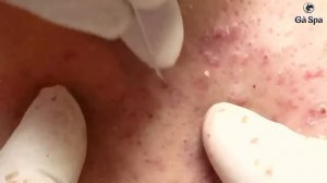 Черные точки на левой щеке: смотрим проблему и сразу лечим GA