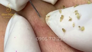 Профессиональное удаление черных точек: работа с порами клиента (23) ｜LN