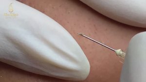 Экстрация наиболее заметных черных точек. LN