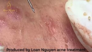 Лечение черных точек и различных видов прыщей (31)｜ LN