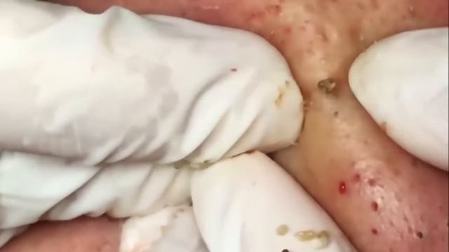 #3 Чистка лица от угрей и акне. Выдавливание прыщей. Удаление черных точек и комедонов