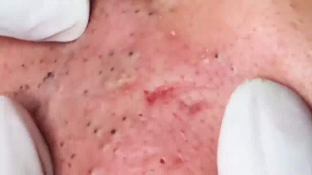 #6 Чистка лица от угрей и акне. Выдавливание прыщей. Удаление черных точек и комедонов