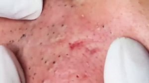 #6 Чистка лица от угрей и акне. Выдавливание прыщей. Удаление черных точек и комедонов