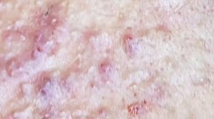 Лучшее выдавливание прыщей, часть 2 - SDS#182