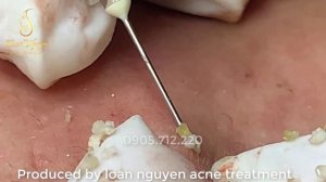 Удаление множества скрытых прыщей, черных и белых точек у девушки 30 ｜ LN