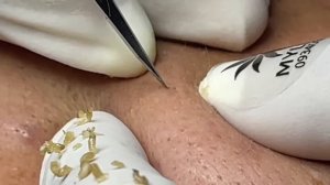 Лечение акне на лице Linh #21 Часть 1