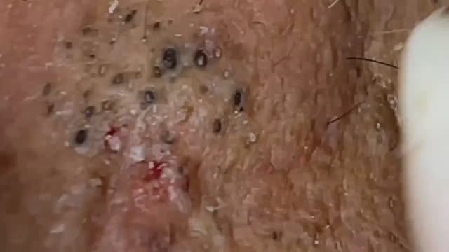 Море черных точек и прыщей за 78 минут 😱 #887628 смотреть онлайн