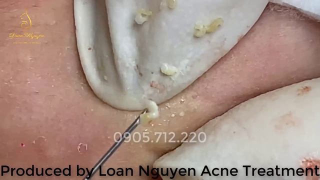 Удаление белых точек (милиумов) на веках и лице LN