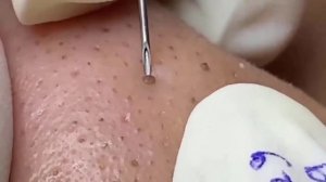 Asmr. Профессиональное очищение от прыщей и милиумов. #500340
