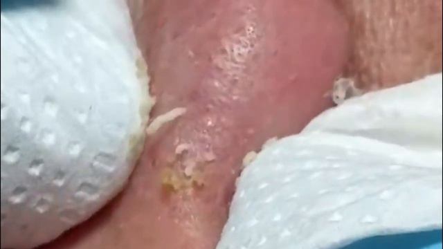 #4Чистка лица от угрей и акне. Выдавливание прыщей. Удаление черных точек и комедонов