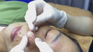 Прыщи, вызывающие рубцы на носу - SDS#199