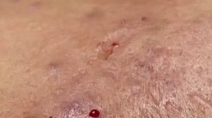 Лечение акне на лице Linh #19 Часть 2