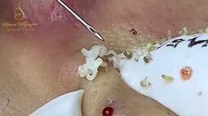 Asmr. Профессиональное избавление от прыщей. LN 27tt (1)