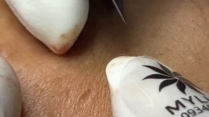 Эффективное лечение угревой сыпи Linh #18 Часть 1