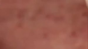 Чистка лица от угрей и акне. Выдавливание прыщей. Удаление черных точек и комедонов