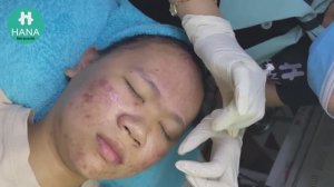 ЛЕЧЕНИЕ АКНЕ: удовлетворение и релакс в одном флаконе 😌 HANA #14