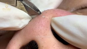 Удаление комедонов на носу — азиатский подход к чистоте   LN