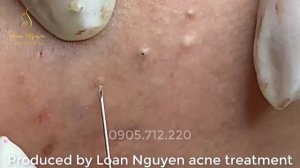 Профессиональный взгляд: находим скрытые акне под чистой кожей (32) LN