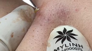 Лечение подкожных прыщей Linh #15