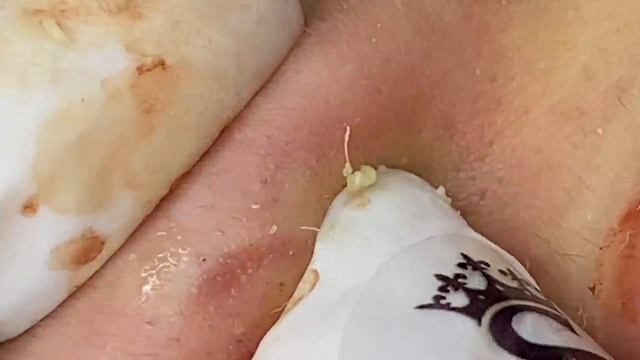 Акне (угревая болезнь) в подростковом возрасте -  SDS#205