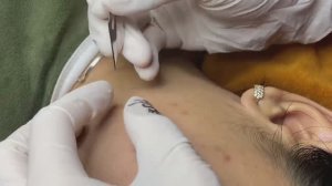 Профессионал правильно выдавливает прыщи и лечит акне  - SDS#201