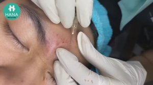 ГИПНОТИЧЕСКАЯ ЧИСТКА: лечим прыщи и медитируем HANA #13