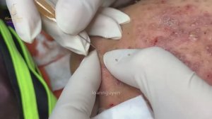 Лечение акне: первый сеанс чистки лица LN