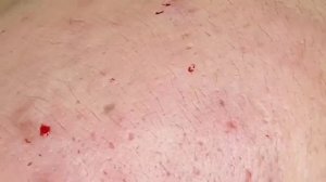 ВРОСШИЕ ВОЛОСЫ И ПРЫЩИ! Кошмар под кожей — часть 1 😱 - SDS#198