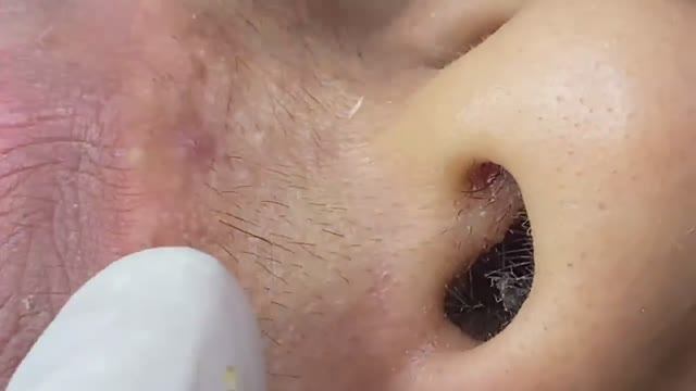 Лучшее выдавливание прыщей, часть 3 - SDS#183