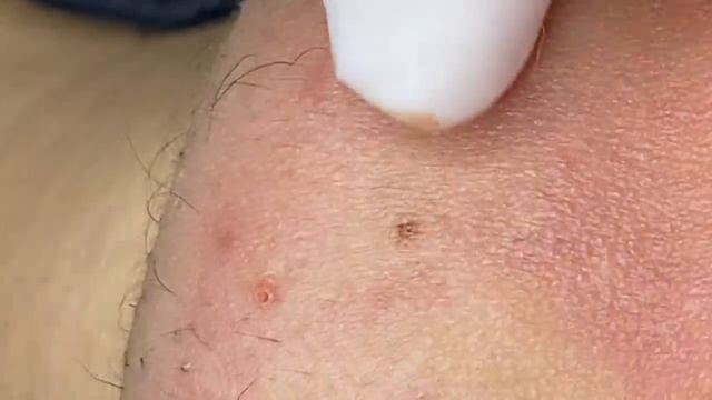 Терапия акне для мужчины SDS#209