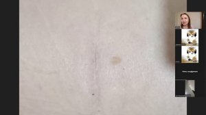 Как избавиться от келоидного рубца Очевидный Невероятный результат