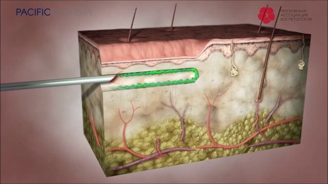 Что такое Иннофил