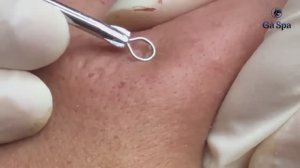 МЕДИТАЦИЯ: удаление комедонов и акне на лице