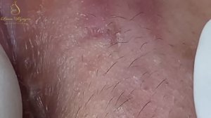 Глубокое очищение пор при угревой сыпи. LN