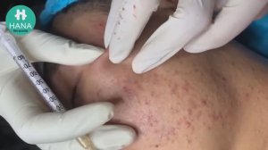 НЕ МОГУ ОТОРВАТЬСЯ! Лечение акне, от которого кайфуешь HANA #08